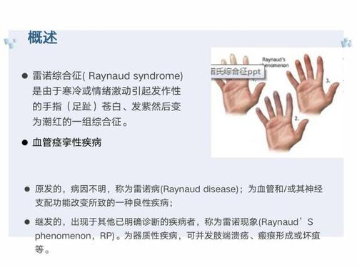 雷诺现象什么病 什么是雷诺现象